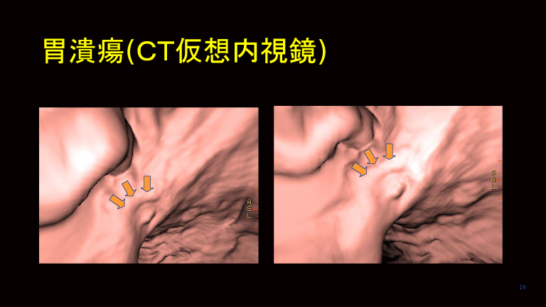 胃潰瘍(ＣＴ仮想内視鏡)